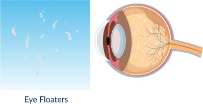 Eye Floaters